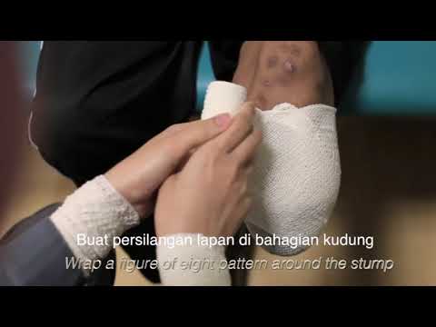 Stump bandaging techniques