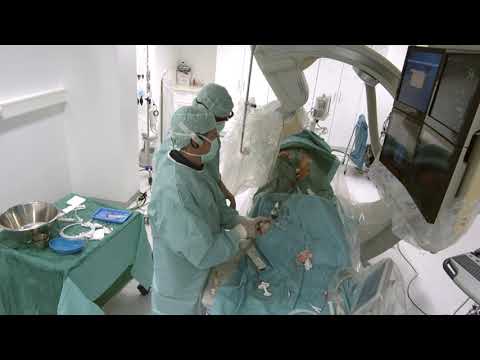 Stern D2 - Live Case #1 - Long Calcified SFA-Occlusion Left - Leipzig, Germany