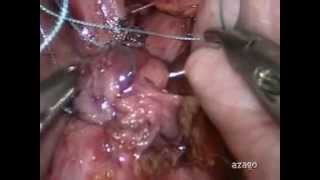preview picture of video 'Azagra & Goergen: Laparoscopic Fundoplication after Roux en Y Gastric Bypass for GERD.mpg'