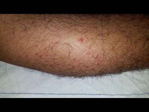 Palpable Purpura HSP || Henoch - Schonlein Purpura