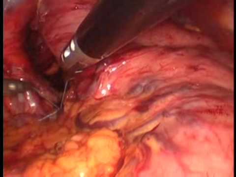 Large Hiatus Hernia Laparoscopic Repair with the Use of Mesh