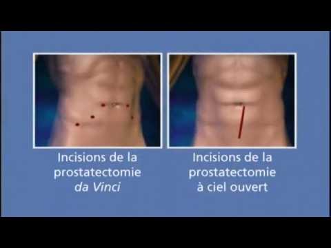 pourquoi se faire operer de la prostate