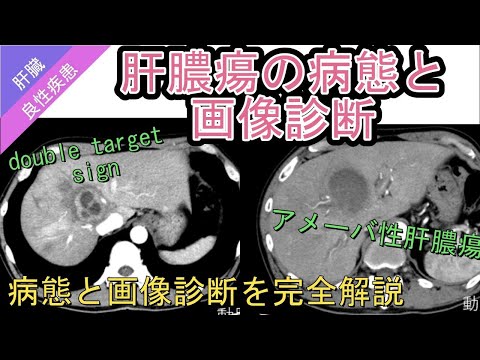 アメーバ性肝膿瘍について詳しく解説