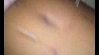 Acupuntura
