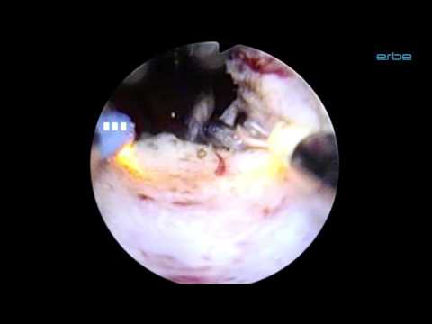 Was bewirkt, dass BPH Porn Prostata Slicing