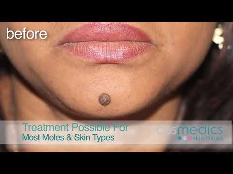 Mole Removal Surgery for Best Results at London & Bristol Clinics