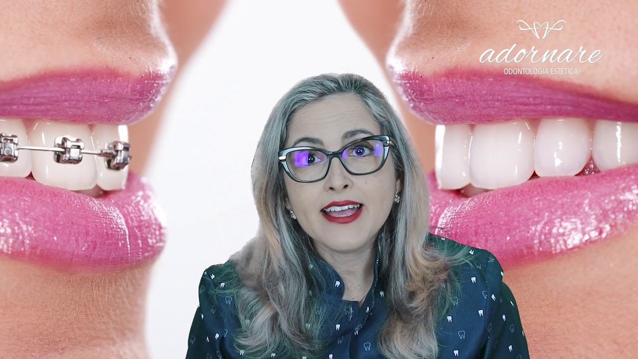 Será que Já Posso Remover o Aparelho Ortodôntico - Dra. Cíntia Amorim - Adornare Odontologia