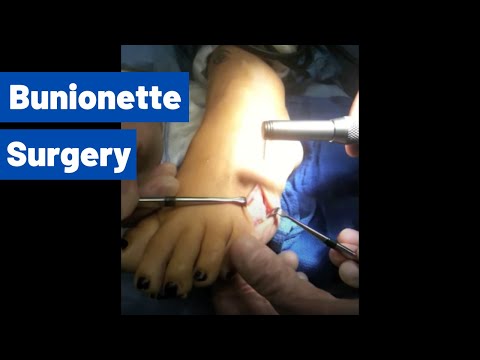 Bunionette Surgery video (Tailor's Bunionectomy)