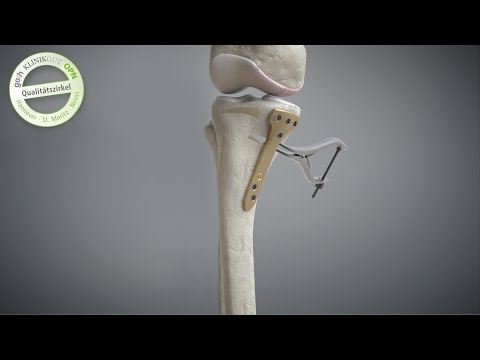 In den Morgen Gelenkschmerzen Entzündung der Schultergelenke Behandlung