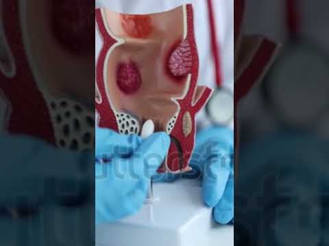 How To insert Suppositories #youtubeshorts #creatingforindia