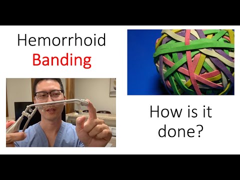 What is a hemorrhoid banding? I show you how it's done!