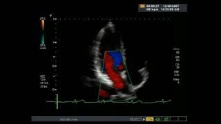 Echocardiogram - Heart ultrasound