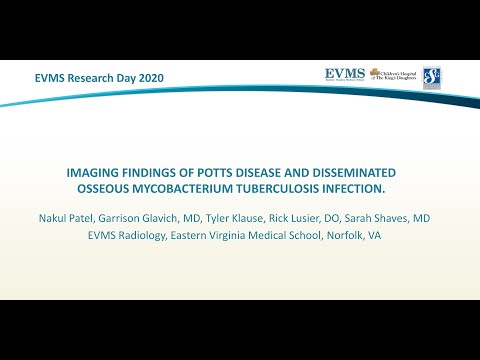 Thumbnail image of video presentation for Imaging findings of Potts disease and disseminated osseous mycobacterium tuberculosis infection