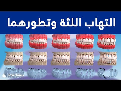 © هاب اللثة وتطورهما