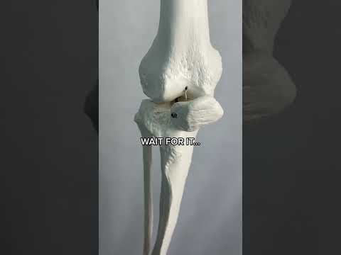 Bone Graft?