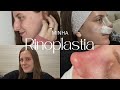DIÁRIO DA MINHA RINOPLASTIA PÓS OPERATÓRIO