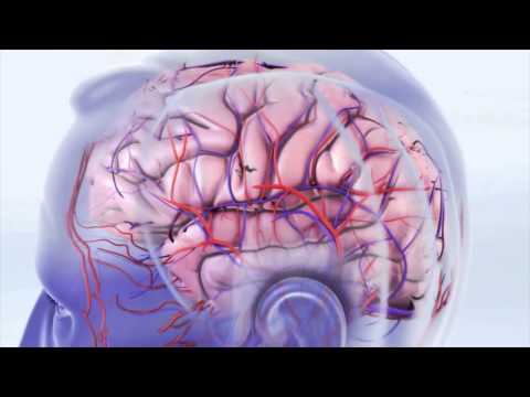 Udar mózgu, część 2: udar niedokrwienny mózgu