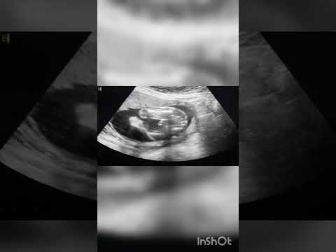 19 weeks boy baby scan