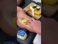 Tattoo Removal Home Remedies Reality Tatoo Kase Hataye Skinaa Clinic Shorts