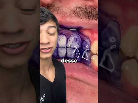 Toda a Verdade sobre o Produto Viral de Clarear Dentes. Explicado! #shorts #clareamentodental