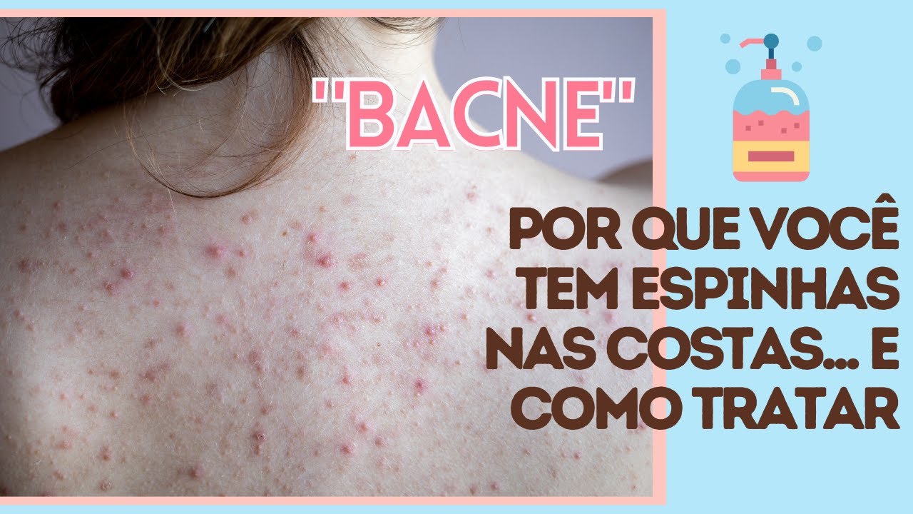 Como tratar espinhas nas costas, colo, braços e pernas | ACNE CORPORAL