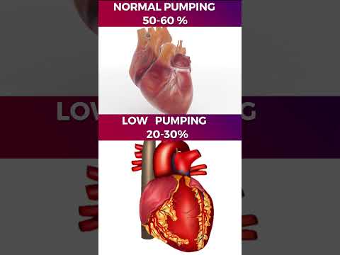 हार्ट की पंपिंग कम होना-Ejection Fraction-What the Numbers Mean