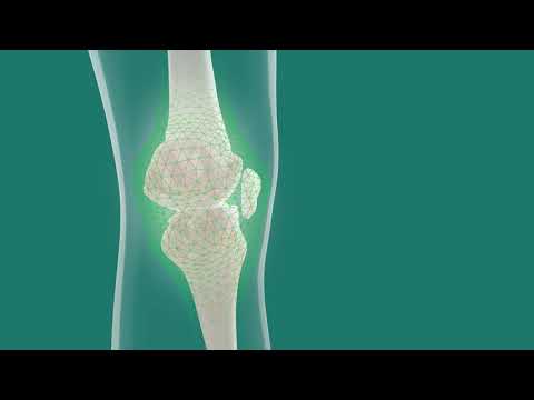 Artroza genunchiului tratament de 3 4 grade