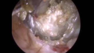 Difficult Case of Keratosis Obturan from Bleeding Ear Removed - Mr Neel Raithatha (The Hear Clinic)