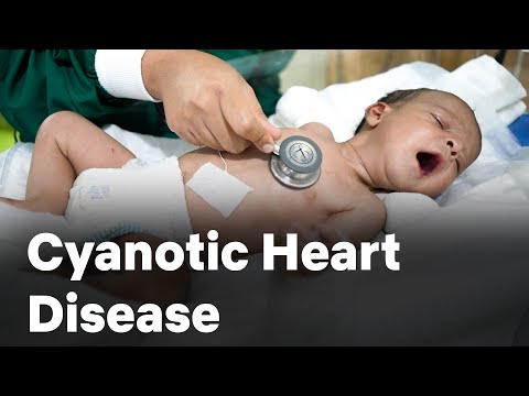 Cyanotic Heart Disease | Congenital | Cardiology | Neonatology | Graphic Era Hospital | GEIMS