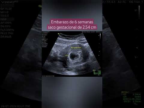 6-WEEK PREGNANCY GESTATIONAL SAC MEASURES 2.54 CM