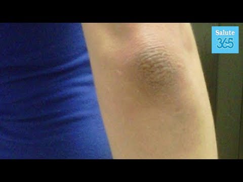 Coxartrosi, esame del sangue hip Articolazioni e della colecisti