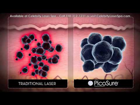 Picosure Laser Tattoo Removal Video
