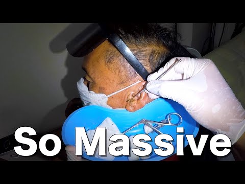 Massive Earwax Removed From Man's Ear