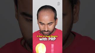 Amazing Hair Transplant Results | Latest Fue Technique #shorts #viral 