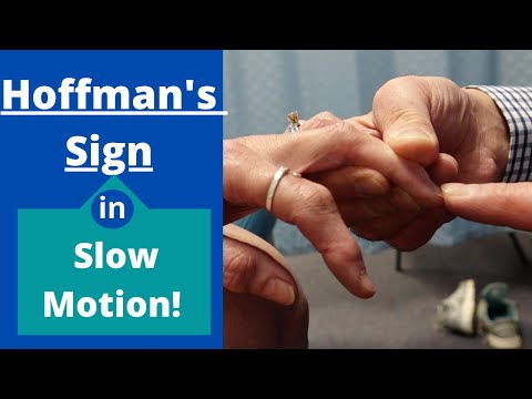 Hoffman's Sign: Slow Motion Video