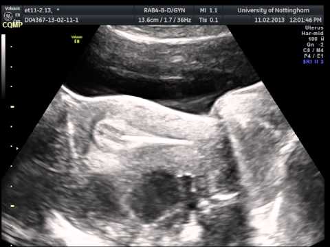image-When is ultrasound done after embryo transfer?