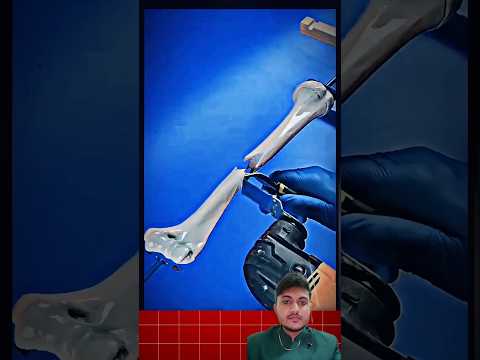 Leg bone fracture #bonefracture #bonesurgery #orthopediccare #viral