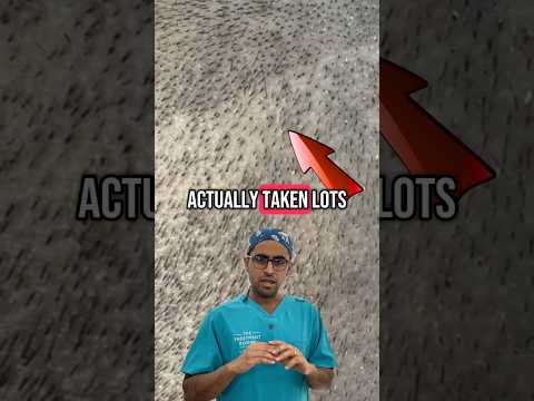 Donor area after hair transplant #hairtransplantlondon #fuehairtransplant #hairtransplant #doctor