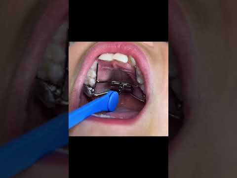 How to Activate an Expander #shorts #expander