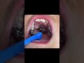 How to Activate an Expander #shorts #expander