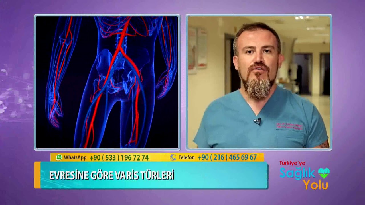 Varisin Lazerle Ameliyatsız Tedavisi