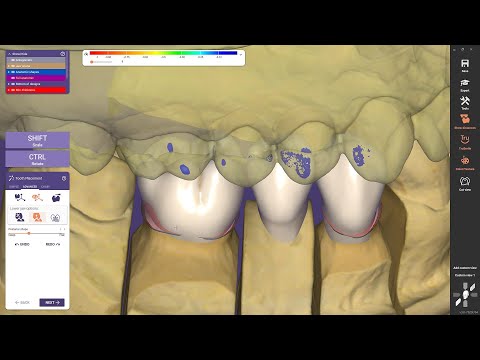 Instant Anatomic Morphing in DentalCAD Galway