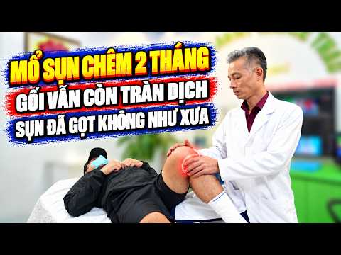 Mổ Sụn Chêm 2 Tháng Đi Lại Bình Thường, Gối Vẫn Tràn Dịch