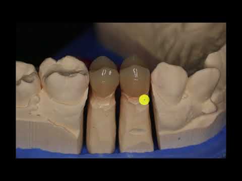 zahnfleischprobleme durch schlechte zahnkronen