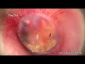 EAR INFECTION With DRAINAGE Time Lapse Video