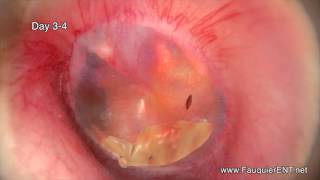 EAR INFECTION With DRAINAGE Time Lapse Video