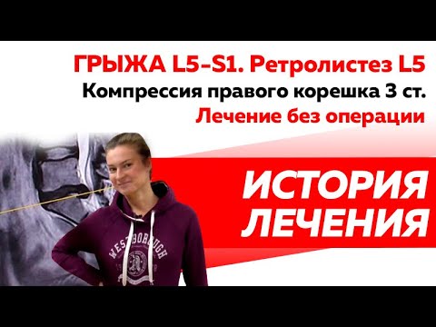 Грыжа L5-S1 с компрессией правого корешка 3 степени. Грыжа более 1 см.