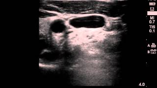 CVC : position of vessels along neck view