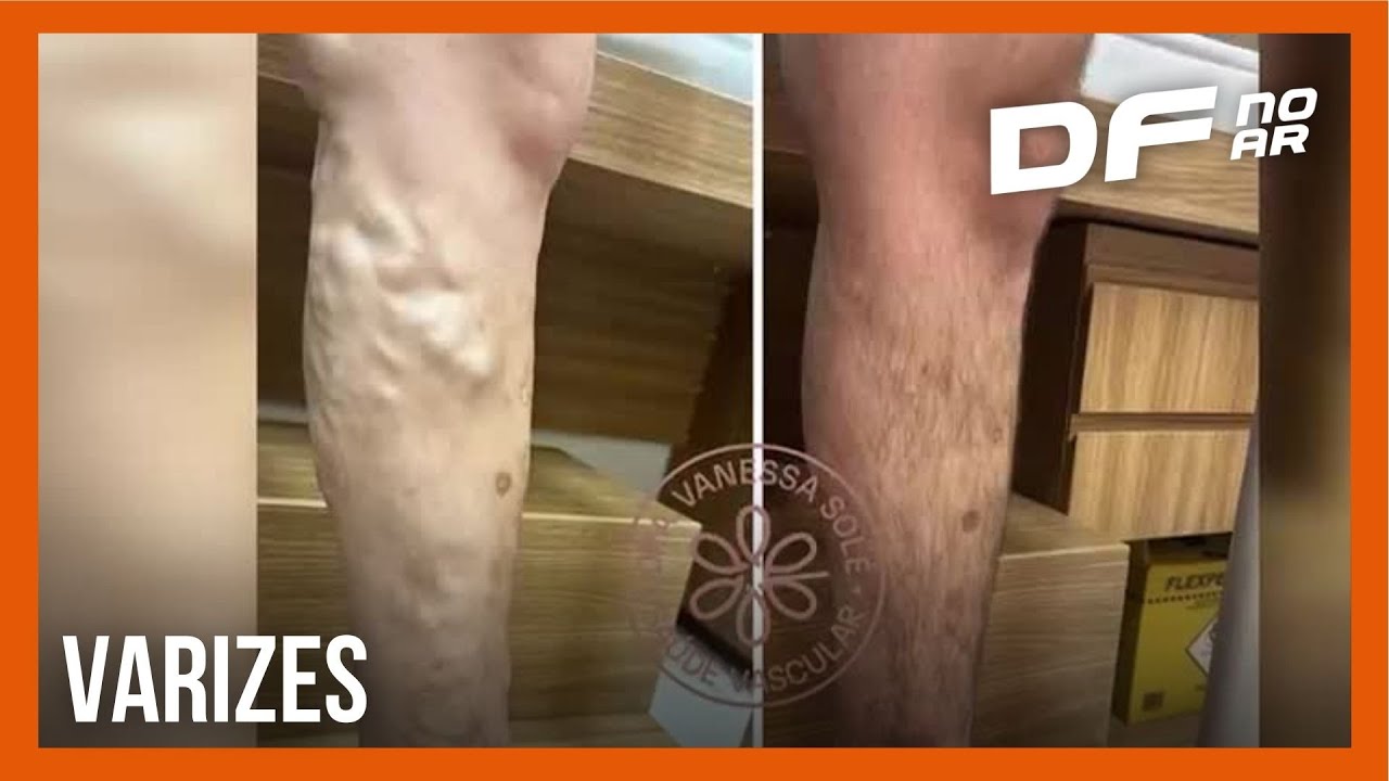 Especialista fala sobre importância do tratamento contra as varizes | DF no Ar