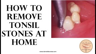 How to remove tonsil stones at home - Tonsil stone